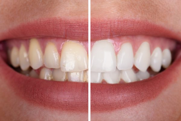 Teeth Whitening Kallison Ranch TX