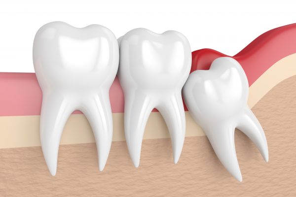 Wisdom Teeth Removal Alamo Ranch TX